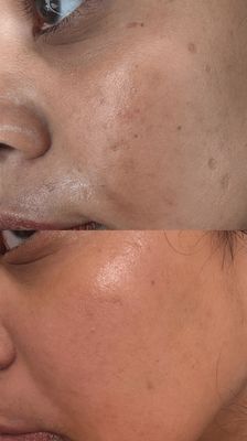 Niacinamide 10 TXA 4 Serum for Brightening and Dark Spots