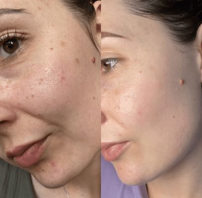 Niacinamide 10 TXA 4 Serum for Brightening and Dark Spots